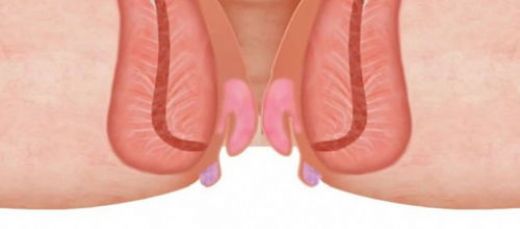 Basur Memesi Şişliği Nasıl İner?