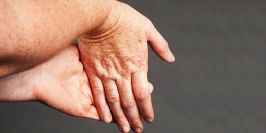 El Bileğinde Şişlik Belirtileri ve Tedavisi