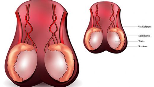 Yumurtalıkta Şişlik Belirtileri ve Tedavisi